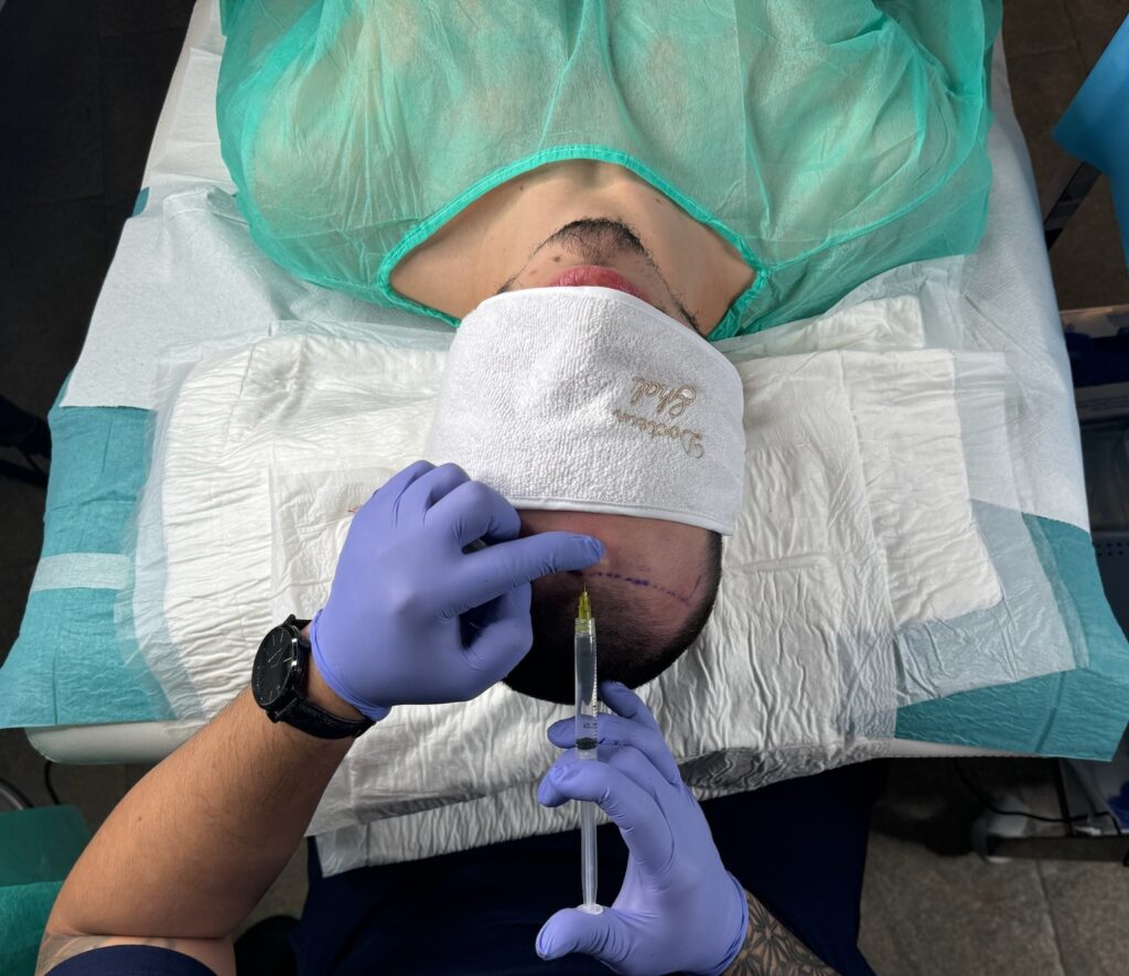 Injection d'anesthésiant dans le cadre de la préparation d'une greffe capillaire dans le centre esthétique du Dr Ghali à Saint Remy de Provence en France