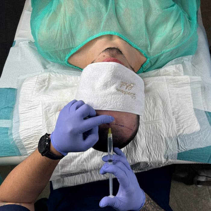 Injection d'anesthésiant dans le cadre de la préparation d'une greffe capillaire dans le centre esthétique du Dr Ghali à Saint Remy de Provence en France