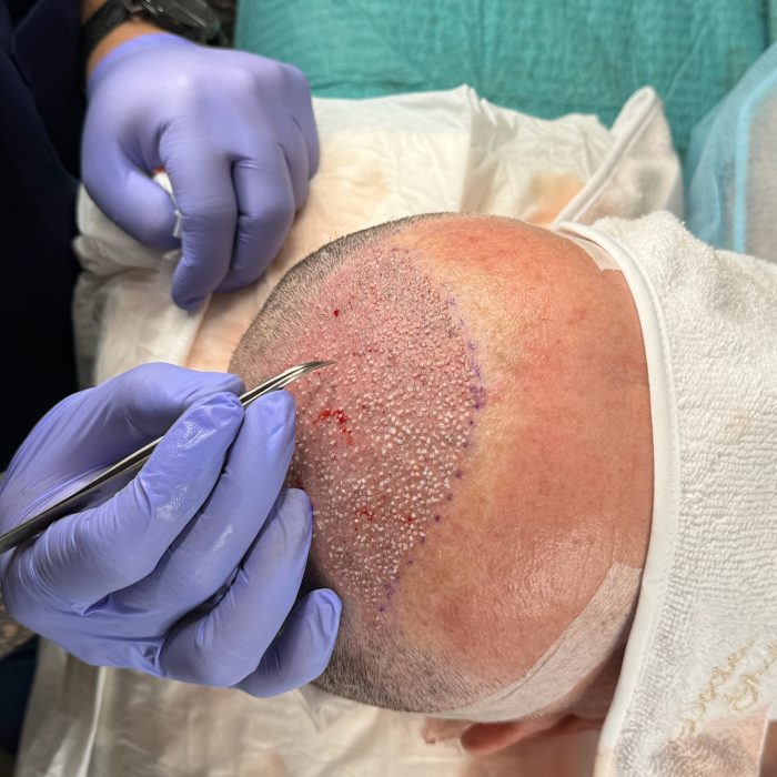 Greffe de cheveux finaliser chez un patient mature de 50 ans dans le centre esthétique du Dr Ghali à Saint Remy de Provence en France